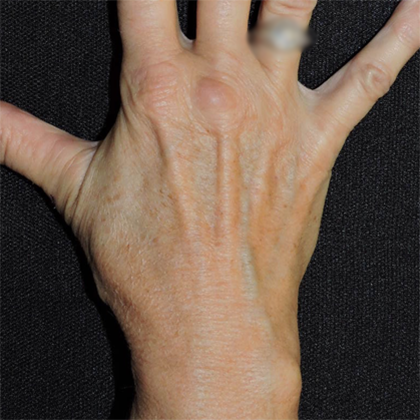 Hand Rejuvenation Before & After Photos