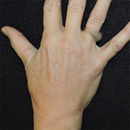 Hand Rejuvenation Before & After Photos