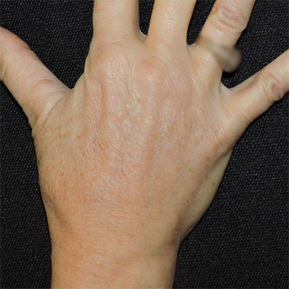 Hand Rejuvenation