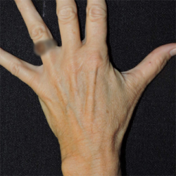 Hand Rejuvenation