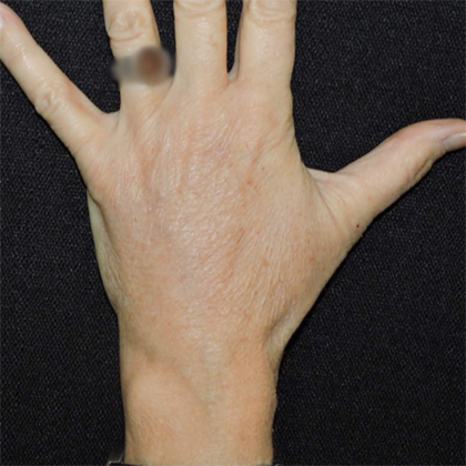 Hand Rejuvenation