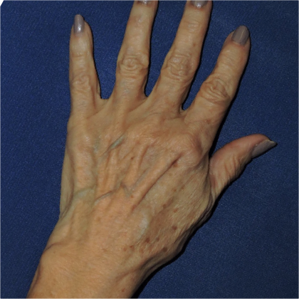 Hand Rejuvenation