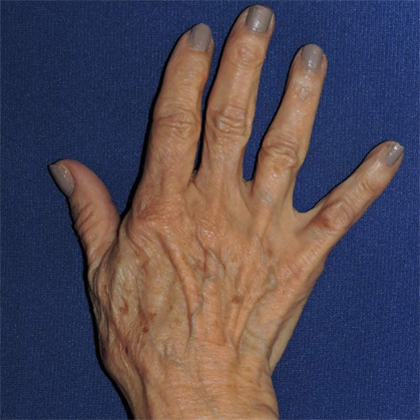 Hand Rejuvenation