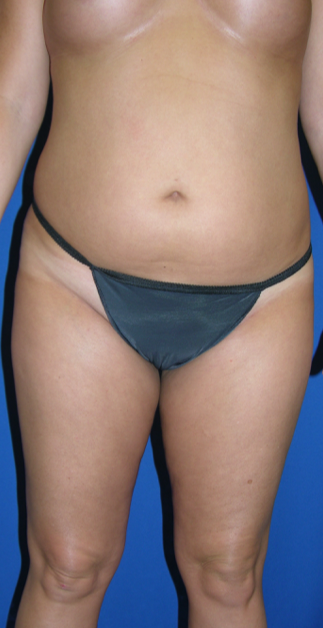 Liposuction