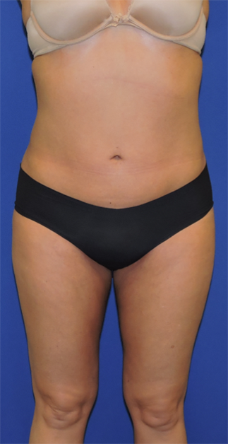 Liposuction