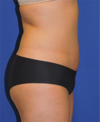 Liposuction