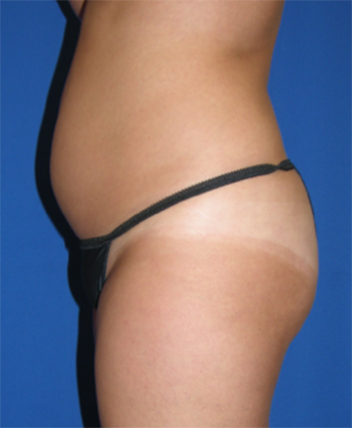 Liposuction