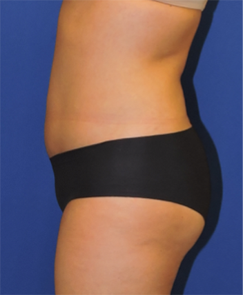 Liposuction