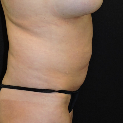 Liposuction