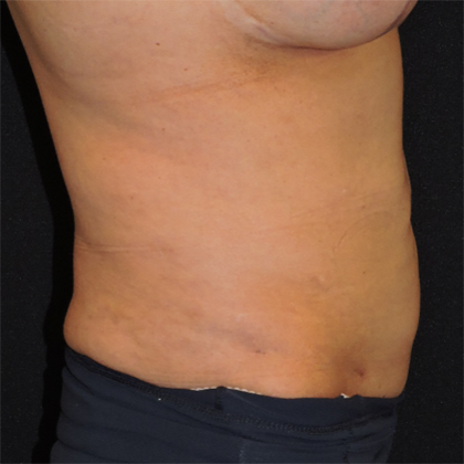 Liposuction