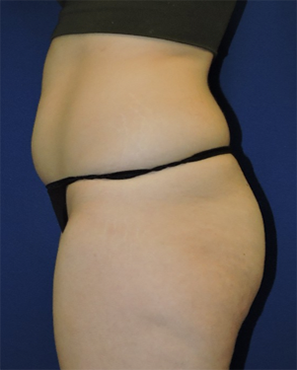 Liposuction