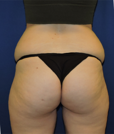 Liposuction