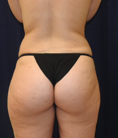 Liposuction