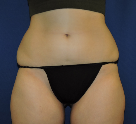 Liposuction