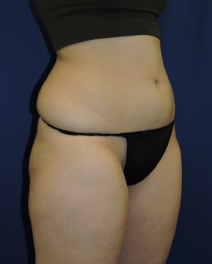 Liposuction