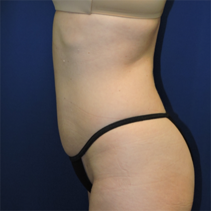 Liposuction