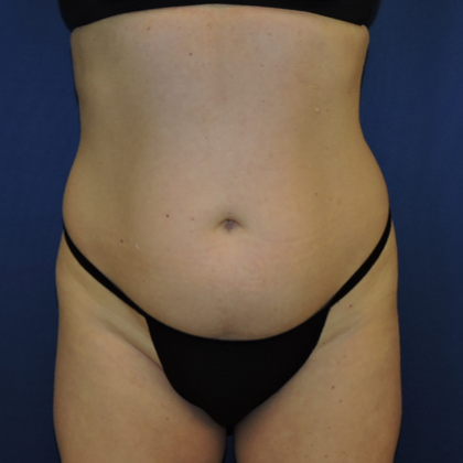 Liposuction