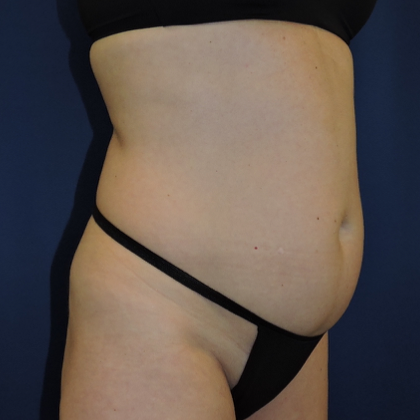 Liposuction