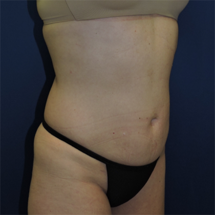 Liposuction