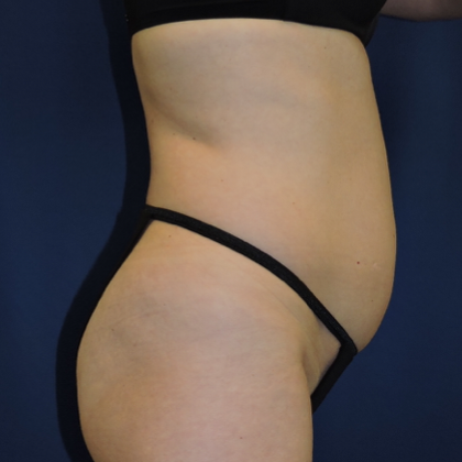 Liposuction