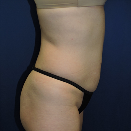 Liposuction