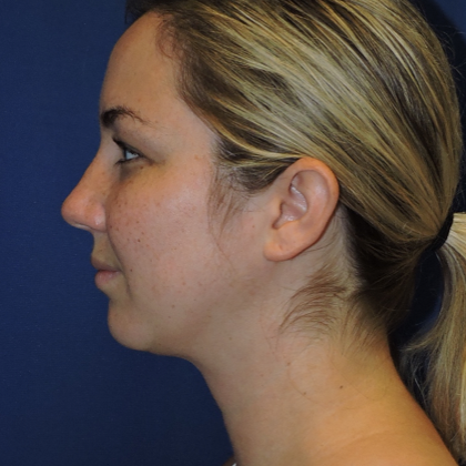 Chin Liposuction