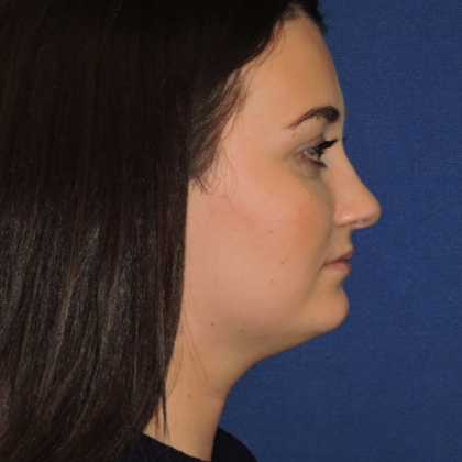 Chin Liposuction