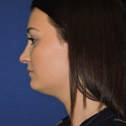 Chin Liposuction