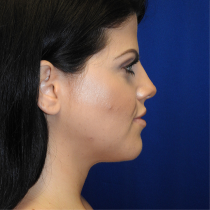 Chin Liposuction