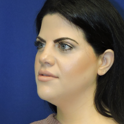 Chin Liposuction