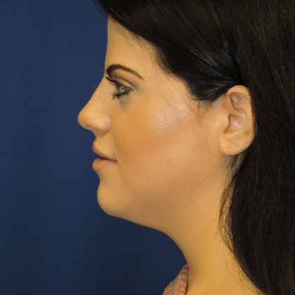 Chin Liposuction