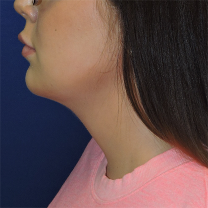 Chin Liposuction