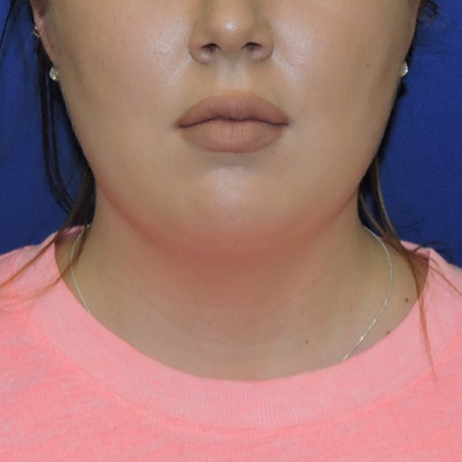 Chin Liposuction