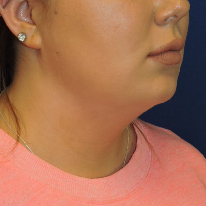 Chin Liposuction