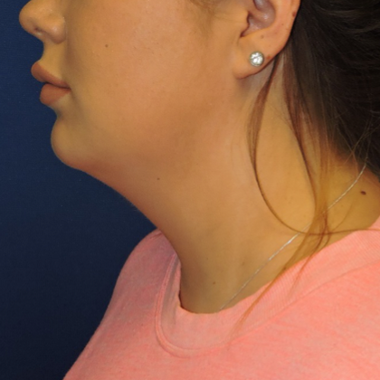 Chin Liposuction