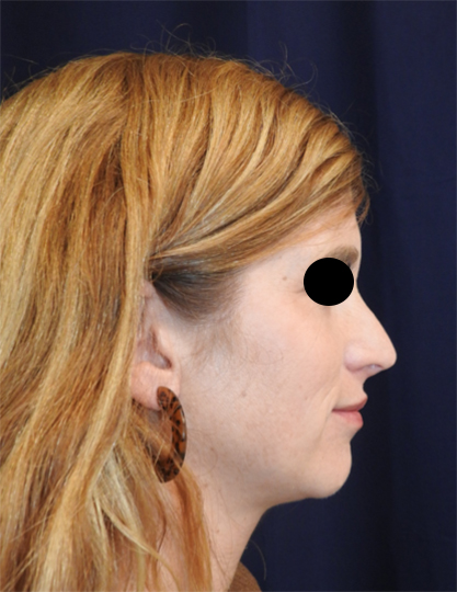 Revision Rhinoplasty