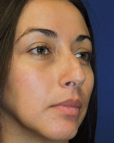 Rhinoplasty