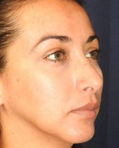 Rhinoplasty