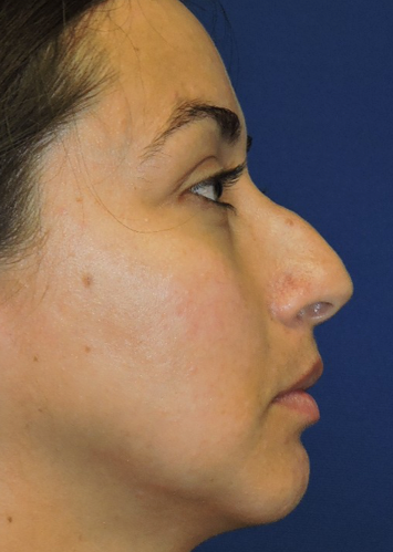 Rhinoplasty