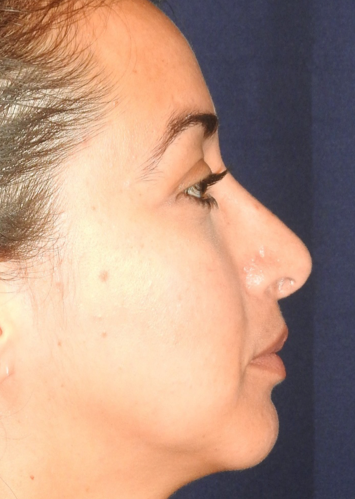 Rhinoplasty