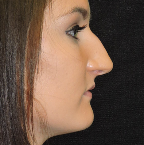 Rhinoplasty