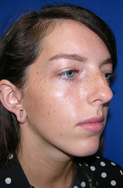 Rhinoplasty