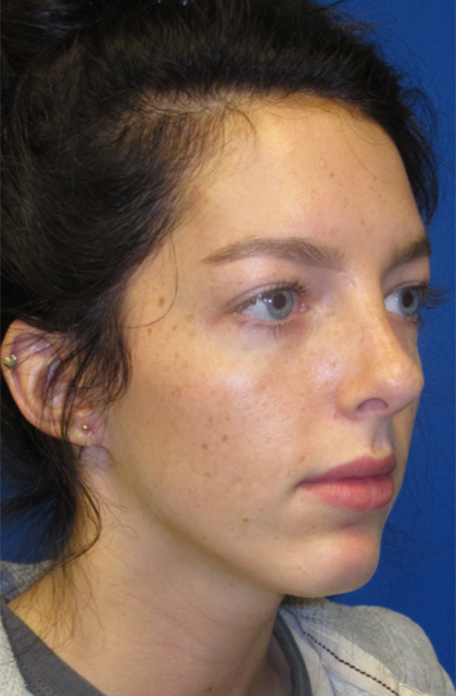 Rhinoplasty Before & After Photos