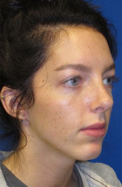 Rhinoplasty