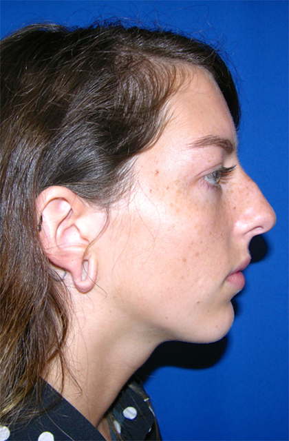 Rhinoplasty