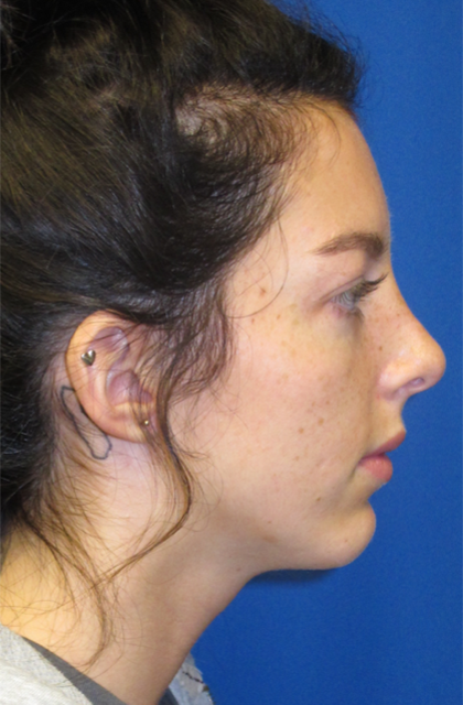 Rhinoplasty