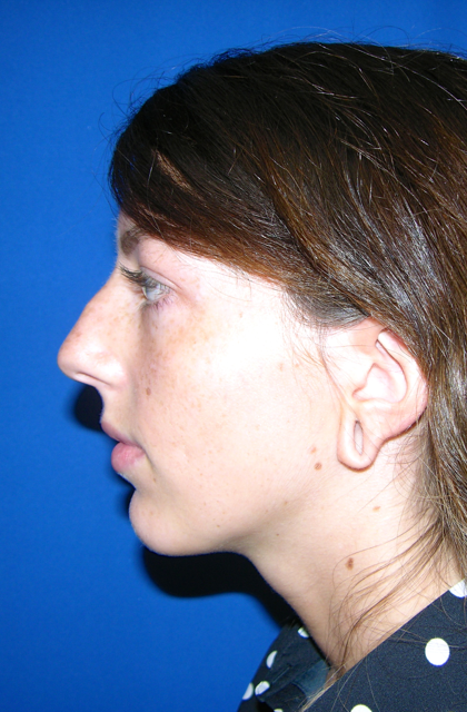 Rhinoplasty