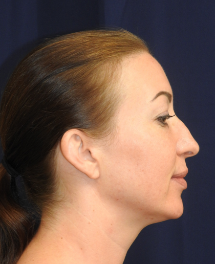 Rhinoplasty