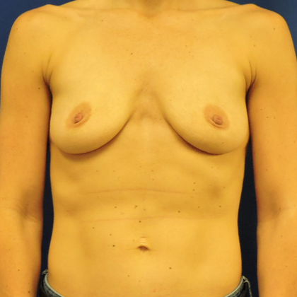 Breast Augmentation