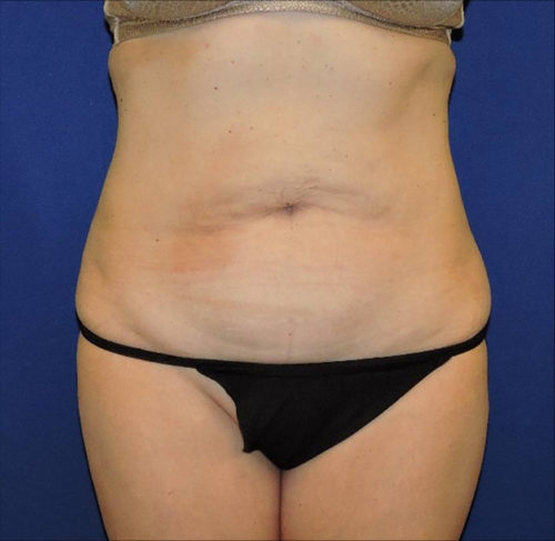 Abdominoplasty